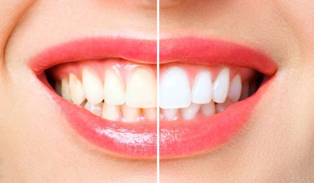 CLAREAMENTO DENTAl