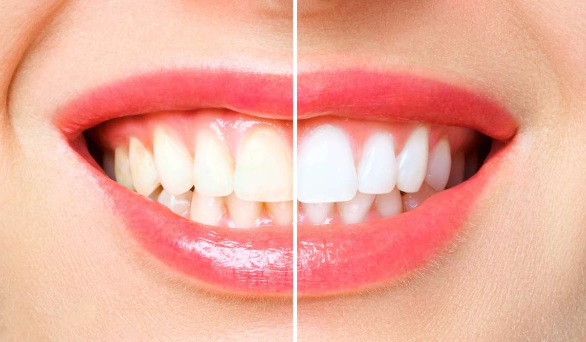 CLAREAMENTO DENTAl